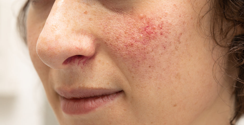 Your Rosacea questions answered by Honey Bee Beautiful