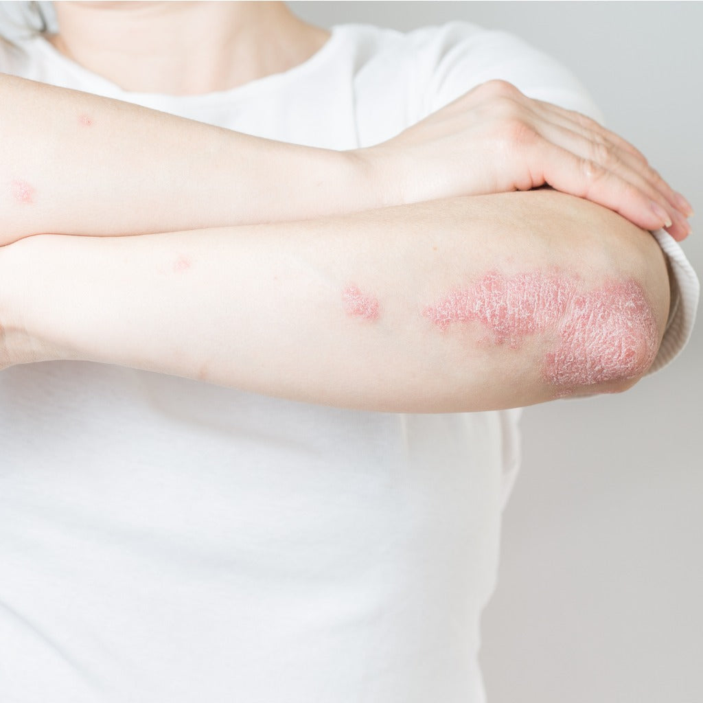 Does Psoriasis Control YOU?  10 Easy Ways to Take Back Control of YOUR Body